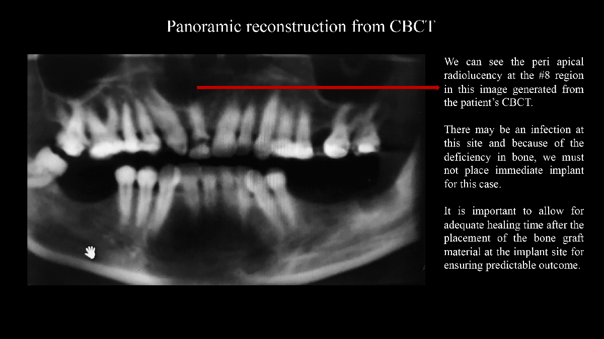 Developing Emergence Profile for an Implant Restoration