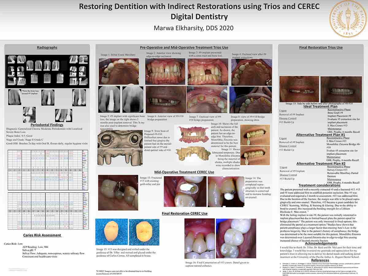 Restoring Dentition with Indirect Restorations using Trios and CEREC Digital Dentistry
