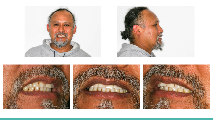 A Multidisciplinary Oral Rehabilitation