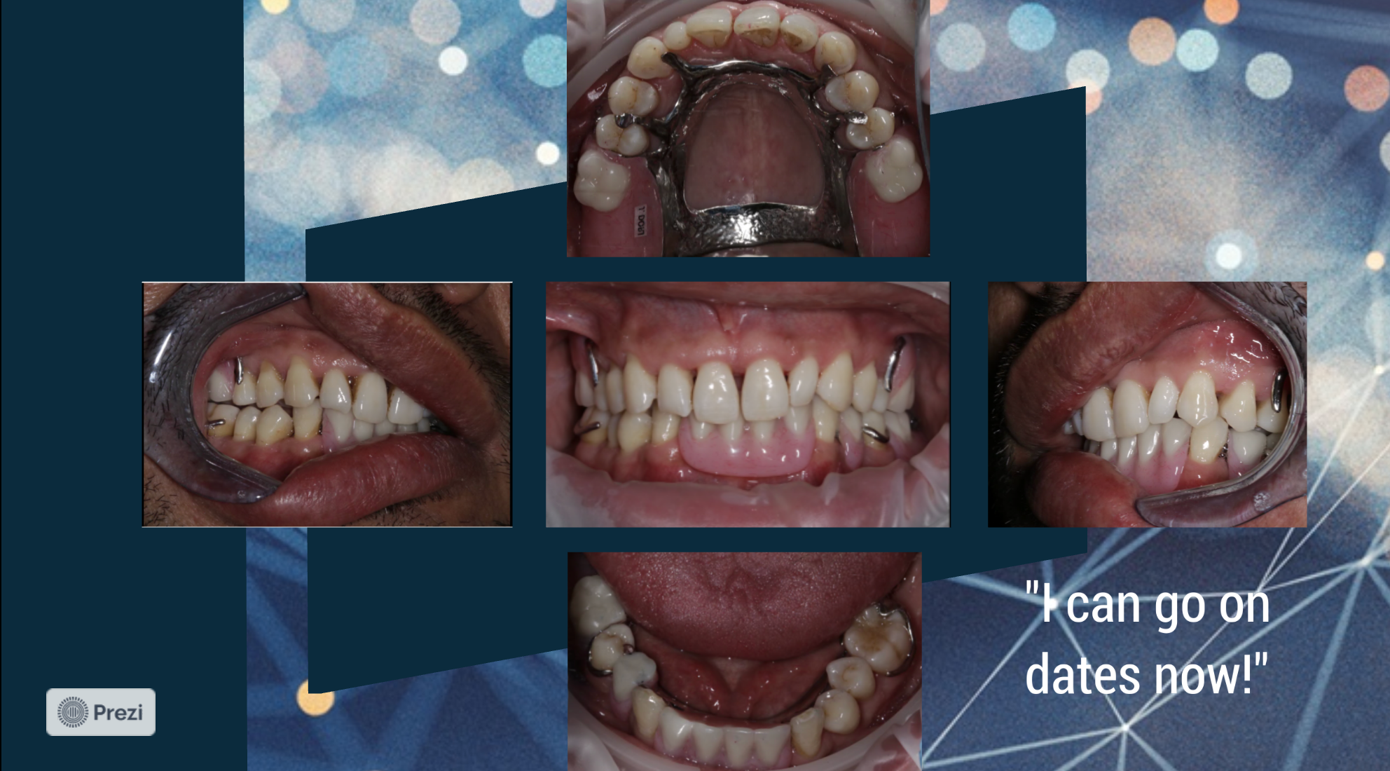 Treating a Patient Who Has Never Been to the Dentist Before With Removable Partial Dentures