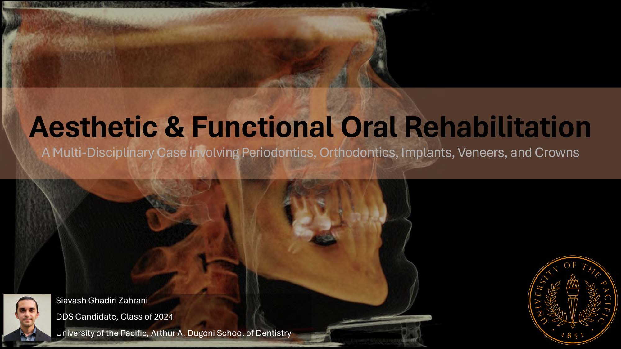 Aesthetic & Functional Oral Rehabilitation: A Multi-Disciplinary Case involving Periodontics, Orthodontics, Implants, Veneers, and Crowns